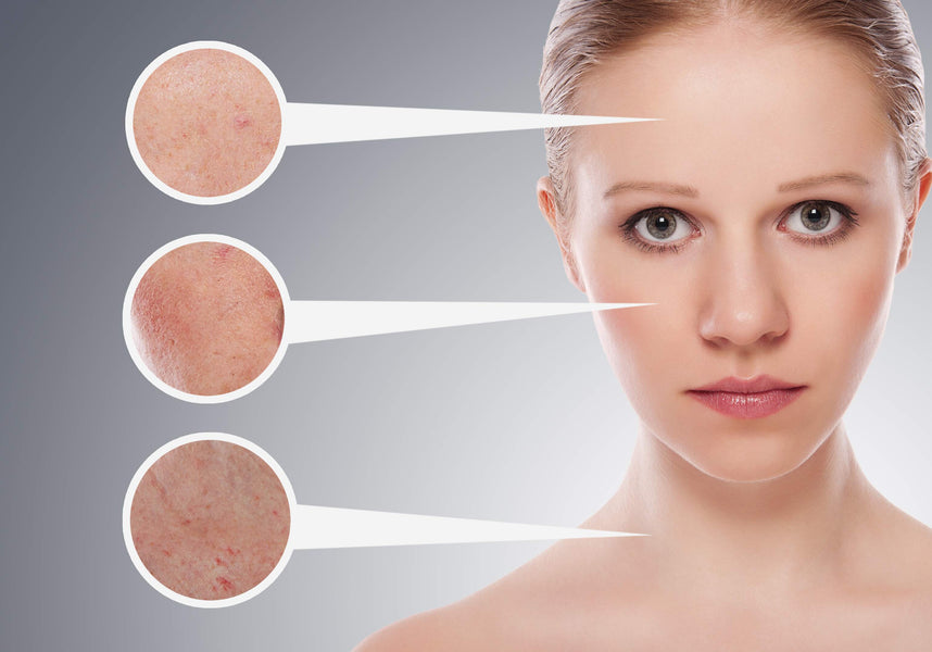 Acne Scars - How to Get Rid of Acne Scars